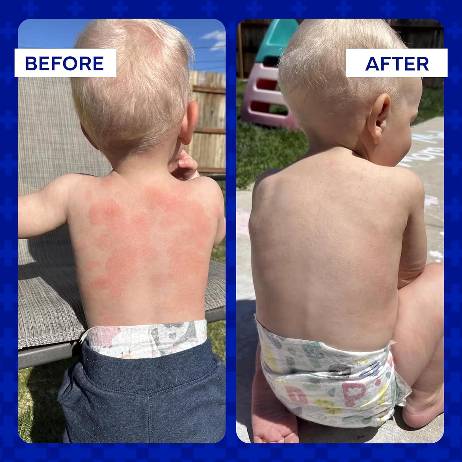 emuaid Ungüento para el alivio del eccema y la psoriasis 59ml